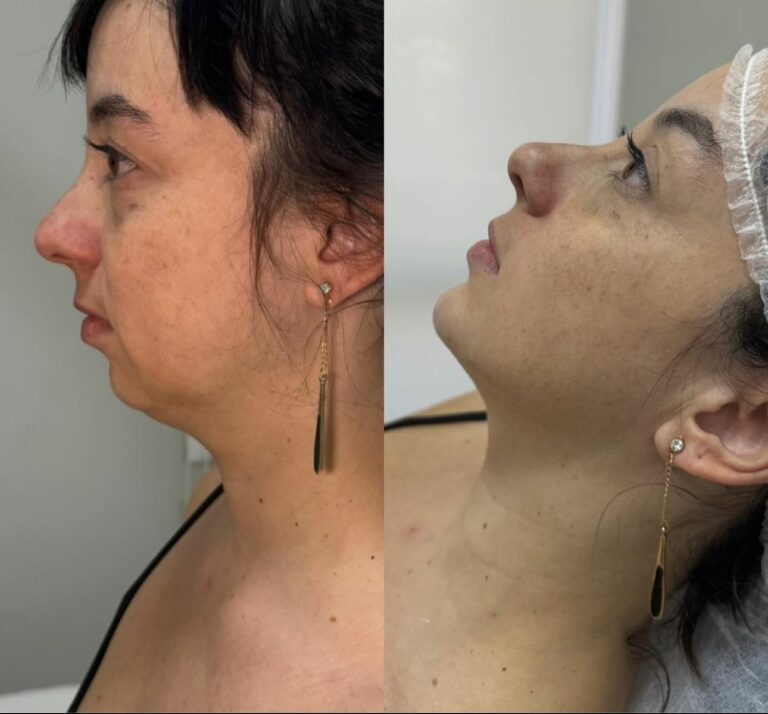 Preenchimento de Mento: A Nova Tendência em Estética Facial