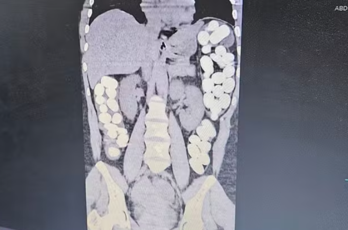 Mulher é investigada por ingerir cápsulas com cocaína, após sofrer crise convulsiva e ser internada em Guarujá