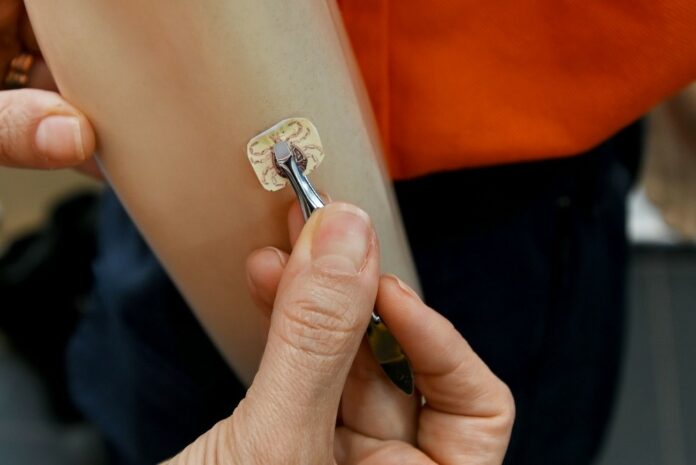 Campinas confirma mais um caso de febre maculosa: idosa sobreviveu Campinas confirma mais um caso de febre maculosa: idosa sobreviveu