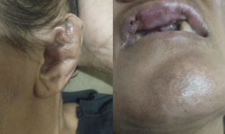 Marido que jogou água quente e arrancou couro cabeludo de companheira em Guarujá é capturado no interior de SP