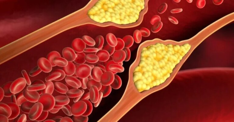 Novo medicamento para tratamento do colesterol é aprovado pela Anvisa