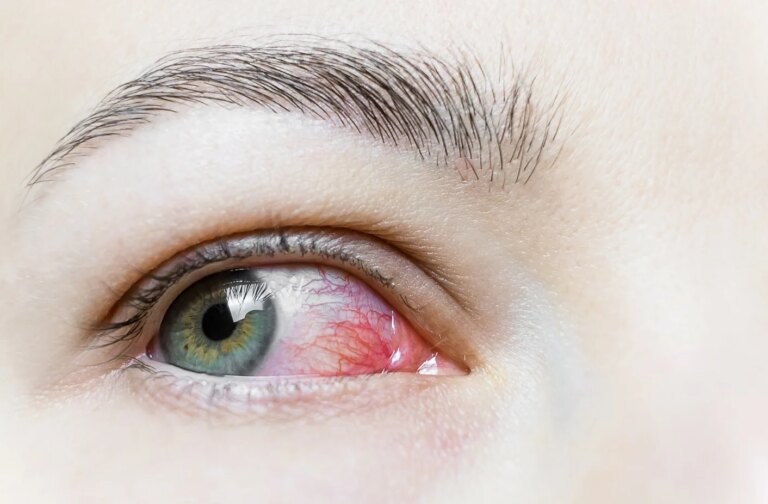 Olhos vermelhos e irritados com frequência? Pode ser blefarite e o tratamento começa com bons hábitos