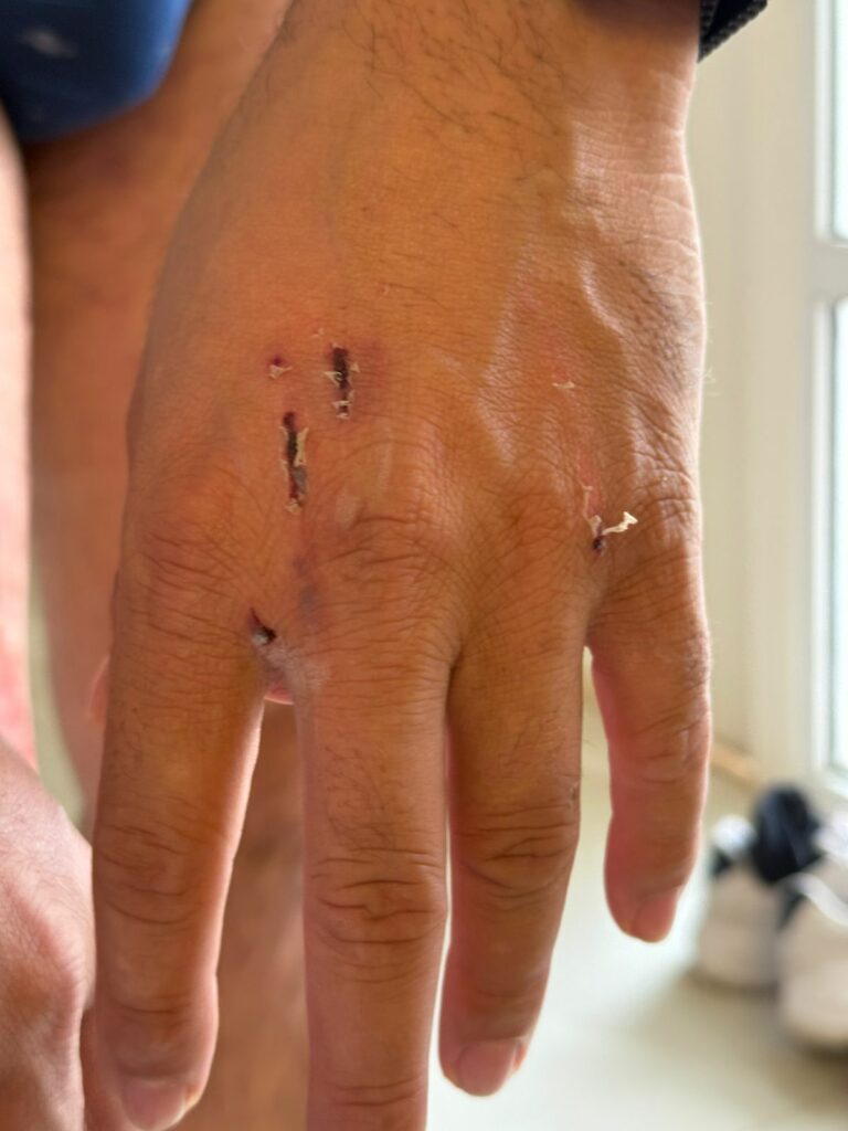 Homem é ferido por pitbull ao tentar socorrer idoso que estava sendo atacado em Piracicaba