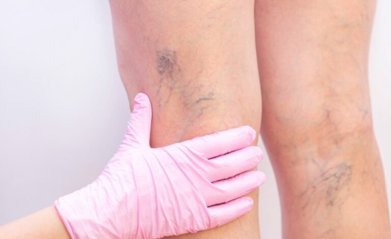 Quando a pele fala pelas veias: sinais que podem indicar doenças vasculares graves