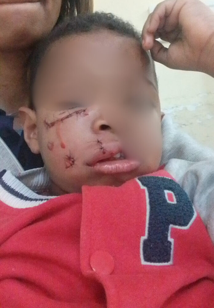 “Não é a primeira vez que esse cachorro escapa”, diz mãe de criança atacada por pitbull em Paulínia