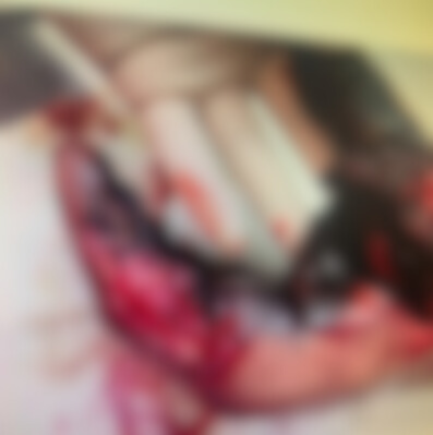 Homem fica ferido após detonação acidental de explosivo em Cunha