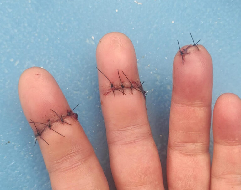 Mulher tem rosto e tendões dos dedos cortados por linha com cerol, em Araçatuba