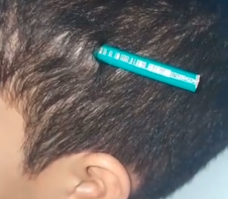 Briga em escola termina com lápis cravado na cabeça de criança em Praia Grande; VÍDEO