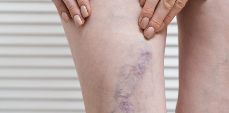 Varizes no inverno: por que essa é a melhor época para tratar o problema vascular