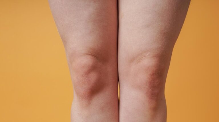 Pernas inchadas: alerta para além do cansaço