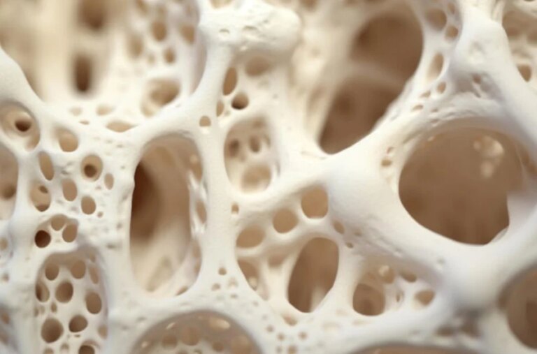 Osteoporose: diagnóstico precoce é crucial para evitar fraturas e salvar vidas