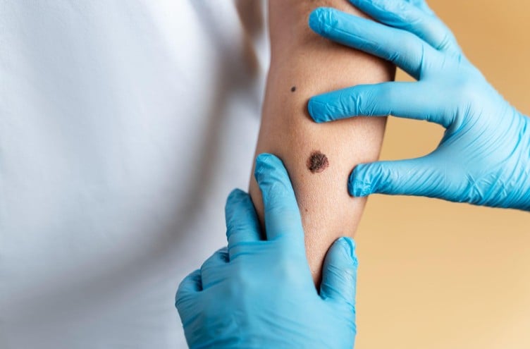 Alerta de Verão: 9 em cada 10 casos de câncer melanoma estão associados à exposição excessiva ao sol