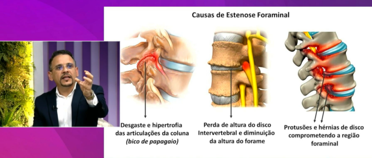 Estenose de canal: estreitamento na coluna pode causar dor, dormência e fraqueza, explica especialista