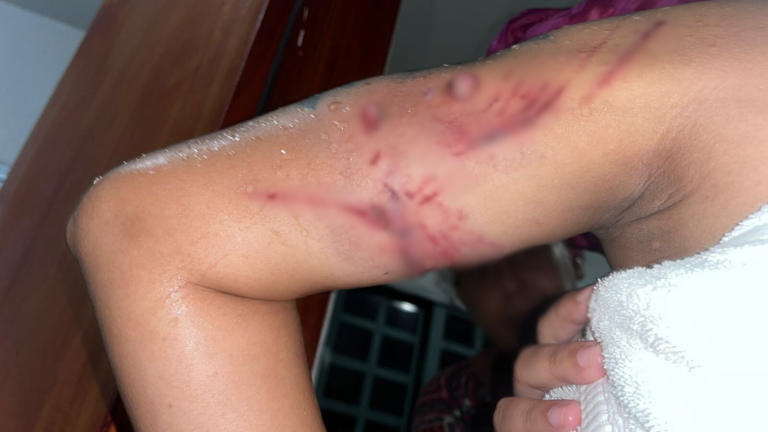 VÍDEO: Ataque de pitbull deixa menina de 4 anos internada em Campinas