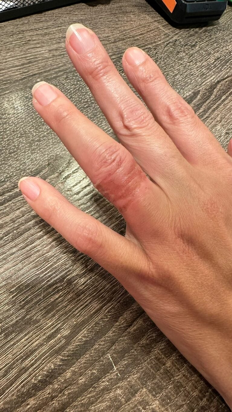 Mulher tem dedo mordido em tentativa de assalto