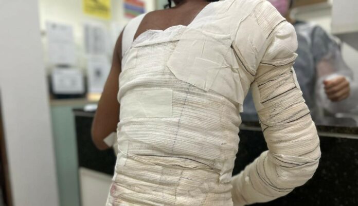 Os números reforçam a preocupação. Até 9 de dezembro de 2025, 1.091 vítimas de queimaduras foram atendidas no hospital