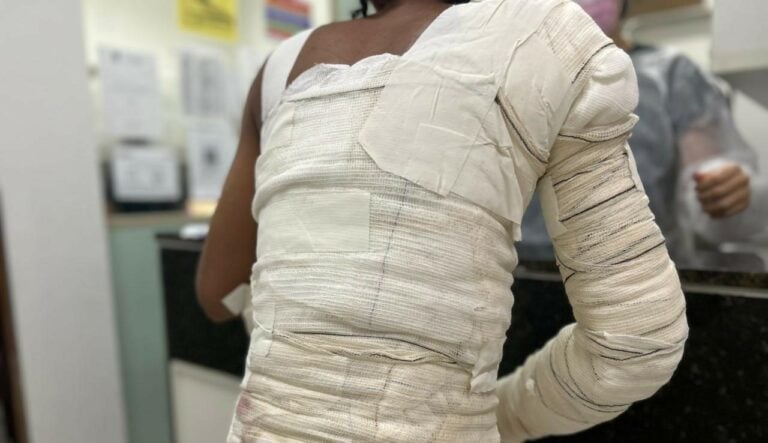 Os números reforçam a preocupação. Até 9 de dezembro de 2025, 1.091 vítimas de queimaduras foram atendidas no hospital