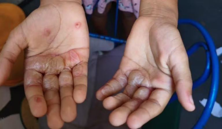 Liberada mulher suspeita de queimar mãos da filha de 6 anos com ovos quentes na PB