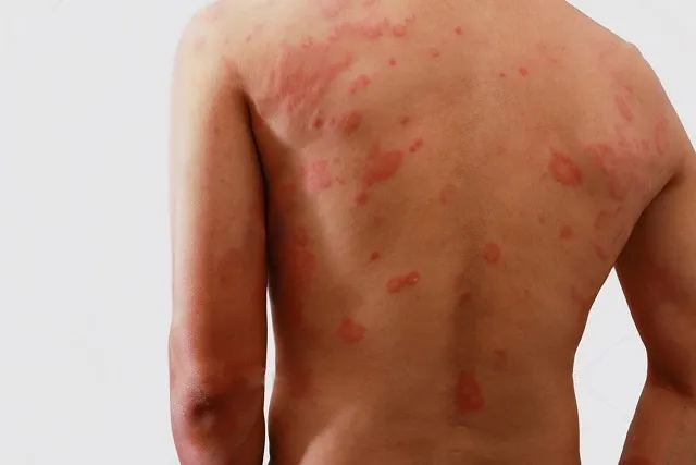 Casos de hanseníase caem na Paraíba e campanha reforça acompanhamento de contatos