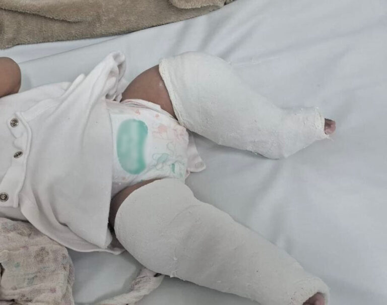 Bebê de 4 meses dá entrada duas vezes no hospital com pernas e braços quebrados