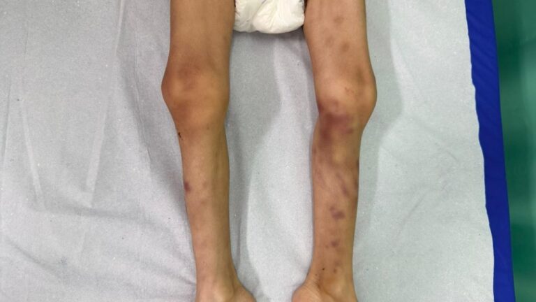 Criança supostamente torturada apresentava desnutrição e não recebia atendimento médico desde 2023