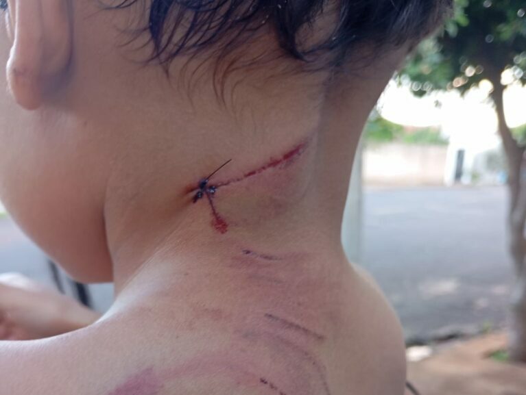 Mulher grávida e filho de 3 anos são atacados por cão em Araçatuba