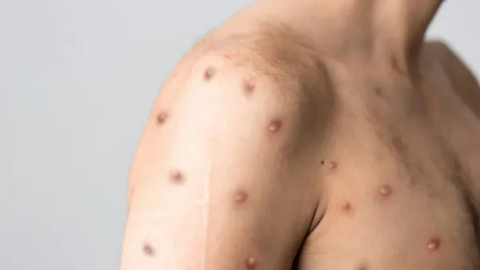 mpox-o-que-e-sintomas-diagnostico-e-tratamentos-eficazes-860x484