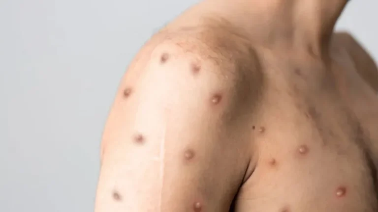 Rio Preto confirma primeiro caso de Mpox em 2026