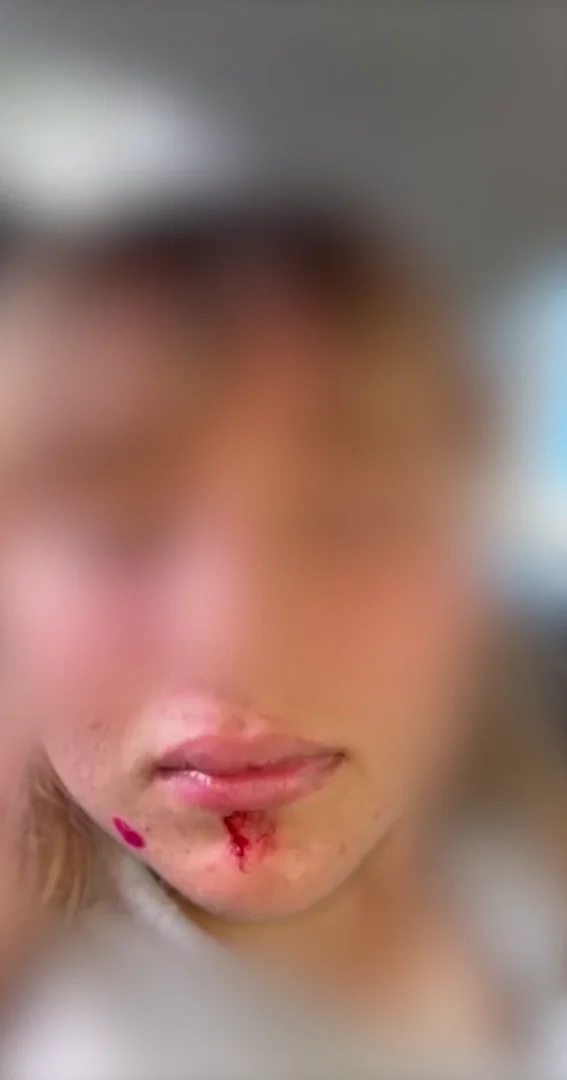 Adolescente sofre fratura no nariz durante briga com colega dentro de sala de aula