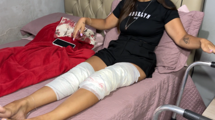 Mãe que ia buscar filha na escola é atacada por pitbull solto na rua 