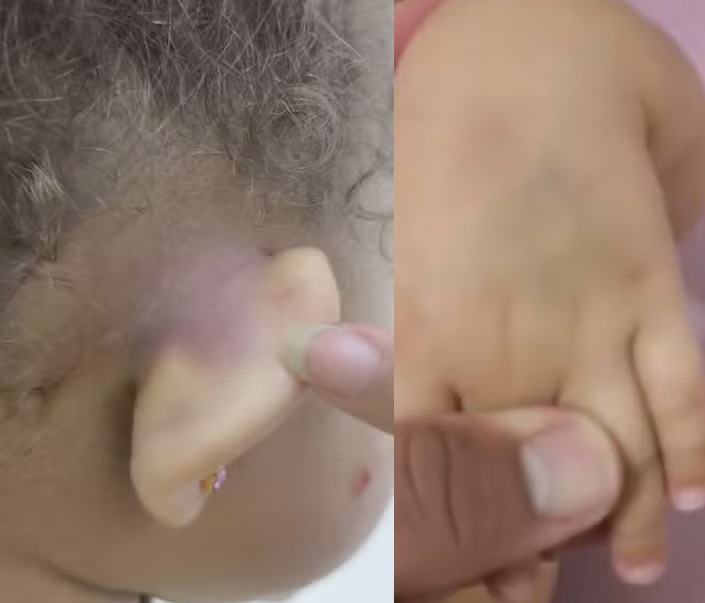 Criança volta da creche com hematomas e família pede explicações