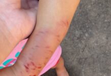 Criança de 2 anos é retirada de creche com mordidas pelo corpo em Araçatuba