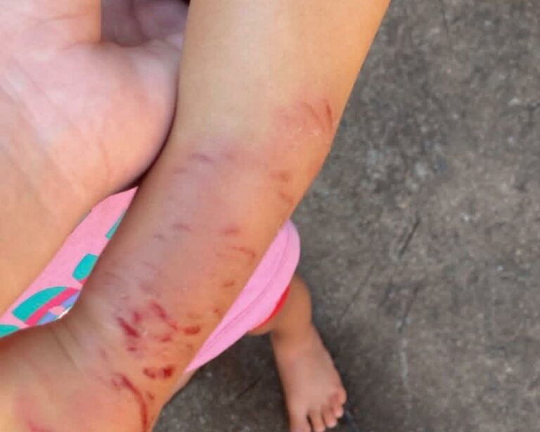 Criança de 2 anos é retirada de creche com mordidas pelo corpo em Araçatuba