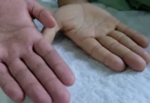 Saiba como identificar a anemia: veja 5 sinais e como prevenir doença