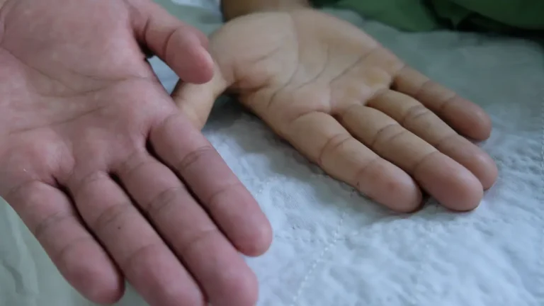 Saiba como identificar a anemia: veja 5 sinais e como prevenir doença