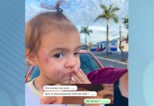 Bebê tem o rosto desfigurado após mordidas de outra criança em creche de Sumaré