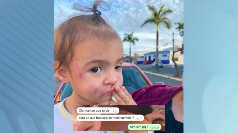 Bebê tem o rosto desfigurado após mordidas de outra criança em creche de Sumaré