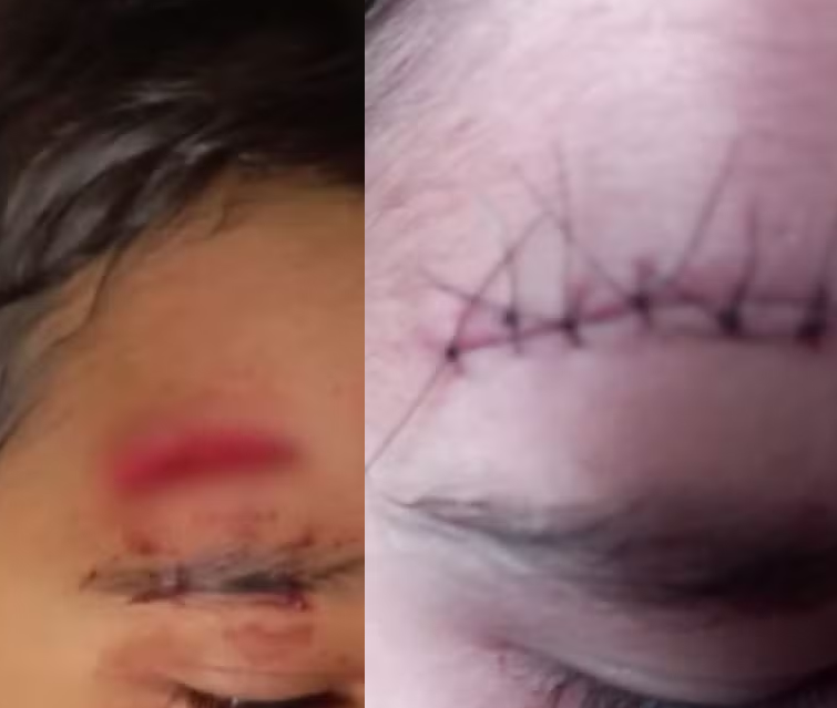 Criança de 6 anos leva pontos na testa após ser empurrada dentro de escola em Registro