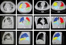 Nova tecnologia feita com IA pode ajudar identificar doenças pulmonares graves