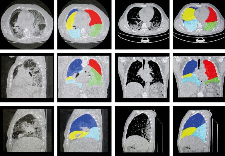 Nova tecnologia feita com IA pode ajudar identificar doenças pulmonares graves