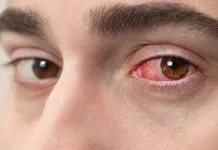 Conjuntivite viral: saiba identificar os sintomas e como evitar a transmissão