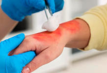 Prevenção de queimaduras no inverno: veja como evitar