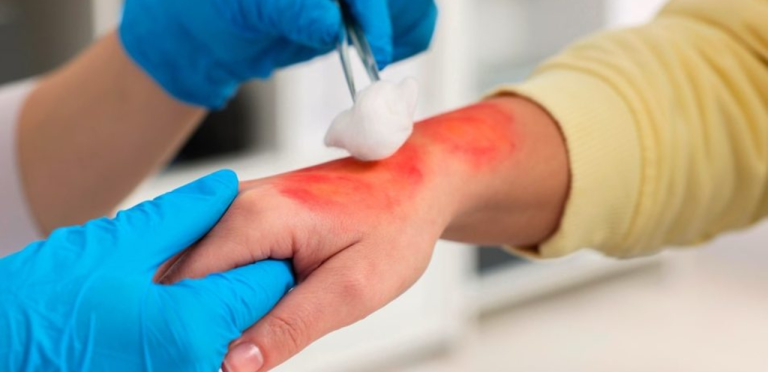 Prevenção de queimaduras no inverno: veja como evitar