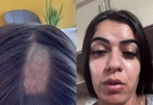 Mulher denuncia falha em exame toxicológico após ficar com falha no couro cabeludo, na PB