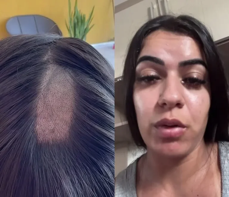 Mulher denuncia falha em exame toxicológico após ficar com falha no couro cabeludo, na PB
