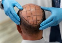 Tratamentos contra queda de cabelo avançam com terapias regenerativas e transplantes precisos