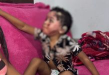 Criança que teve 36% do corpo queimado após explosão de tacho recebe alta em Valinhos