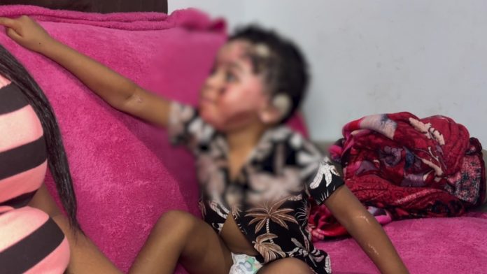 Criança que teve 36% do corpo queimado após explosão de tacho recebe alta em Valinhos