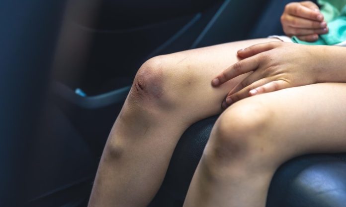 Câncer aumenta risco de trombose durante o tratamento e exige atenção a sinais de alerta