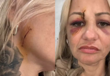 Mulher é agredida e leva 20 pontos no rosto em Praia Grande